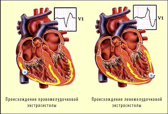 Экстрасистолия на фоне стресса форум