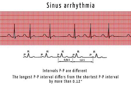 Файл:Sinus arrhythmia.jpg