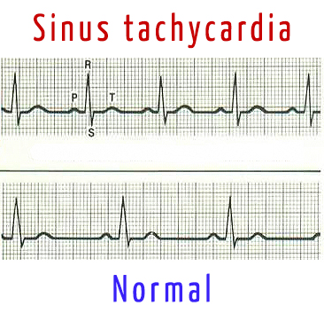 Файл:Sinus tachycardia.jpg