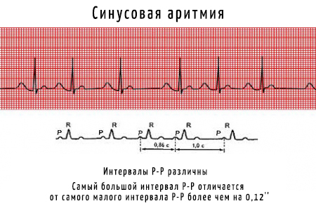 На фоне синусового ритма