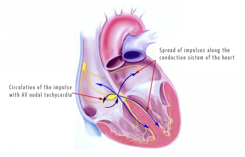 Файл:Atrioventricular nodal re-entrant tachycardia.jpg